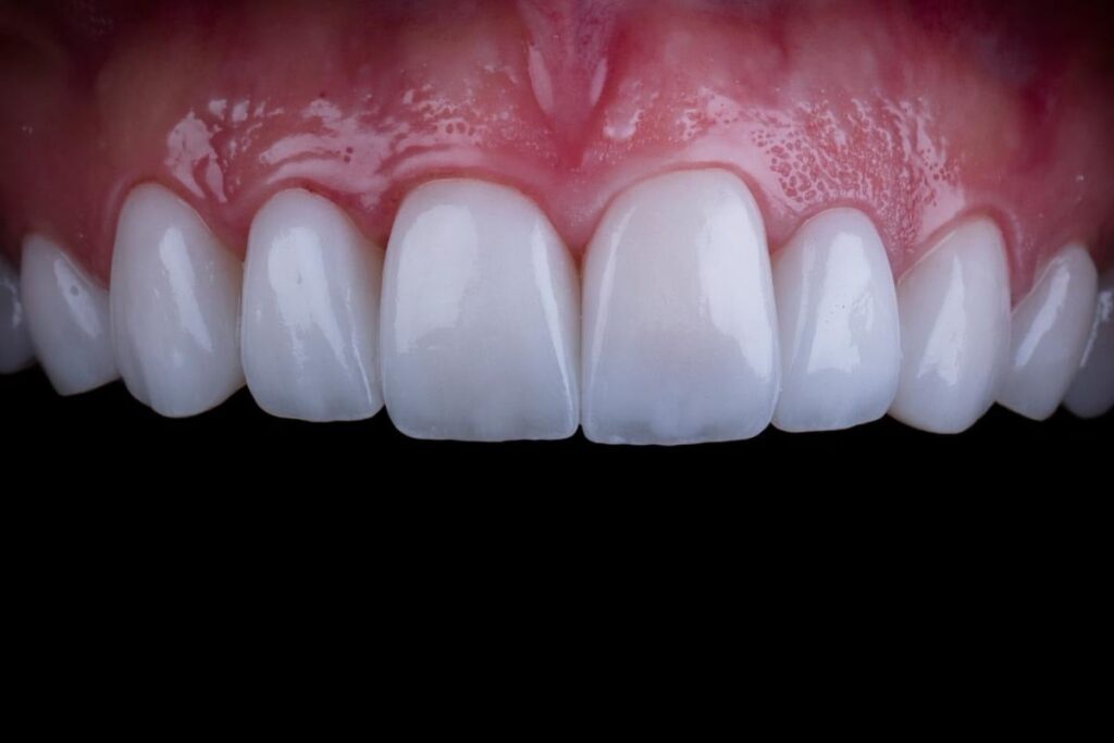 Dental Veneers